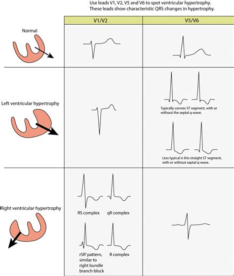 lvh ecg chart